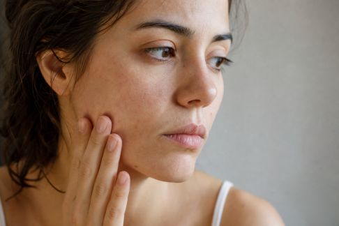 L’impact du stress sur la peau du visage et comment y remédier