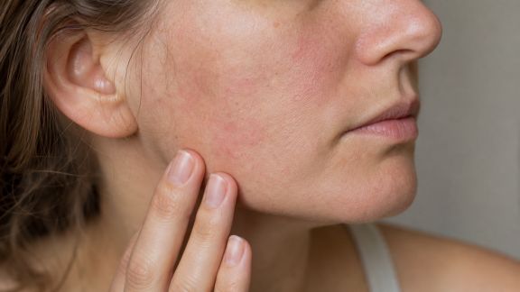 Plaques, tiraillements, picotements : comment reconnaître les signaux d’une peau sensible