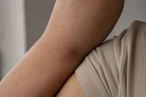 Comment protéger sa peau des frottements liés aux vêtements