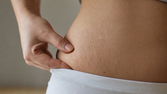 Soins du corps : anticiper et limiter les marques et vergetures